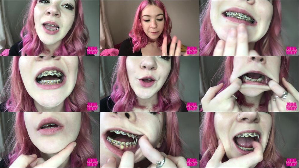 braces fetish