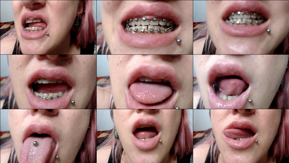 braces with elastic close up - November 28, 2019