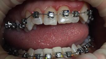braces with elastic close up - November 28, 2019 (YourFetishBrat)